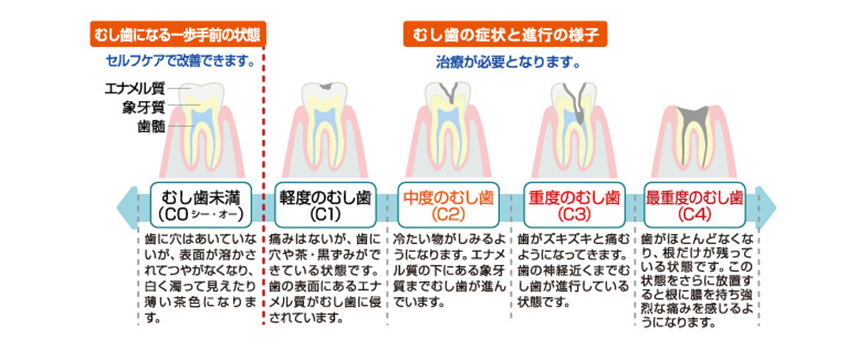 むし歯の進行