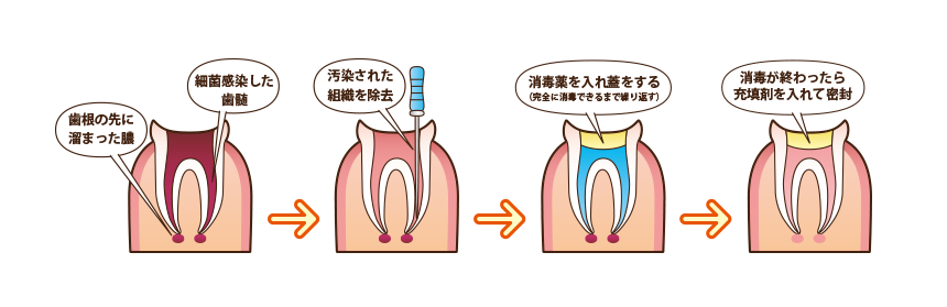 歯を残すための根管治療
