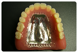 自費金属床義歯