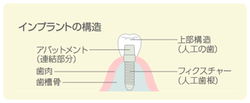 インプラントの構造